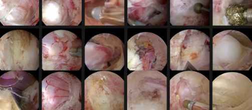 Spinal Endoscopy Training Enrollment Program