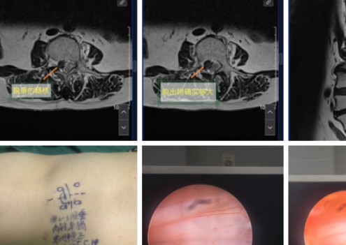 經皮內鏡下腰椎間盤切除術治療腰椎間盤突出症1例